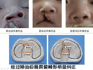 经过矫治后唇腭裂畸形明显纠正